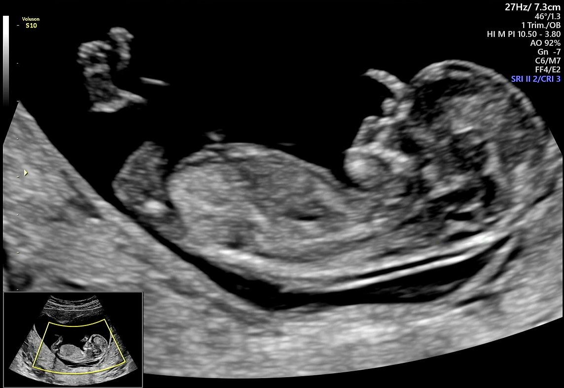 Ultrassonografia 2D: perfil fetal no primeiro trimestre
